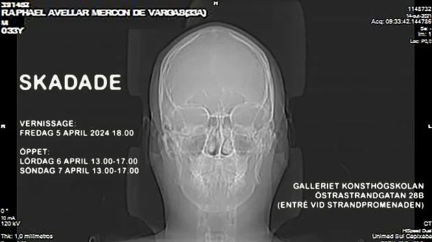 Röntgenbild av mänsklig skalle mot svart bakgrund
